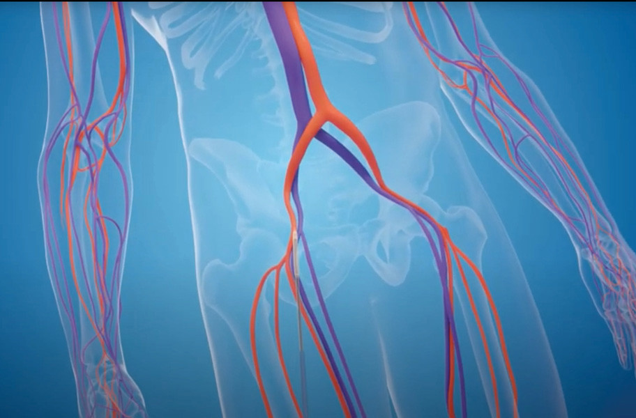 IB Corevalve