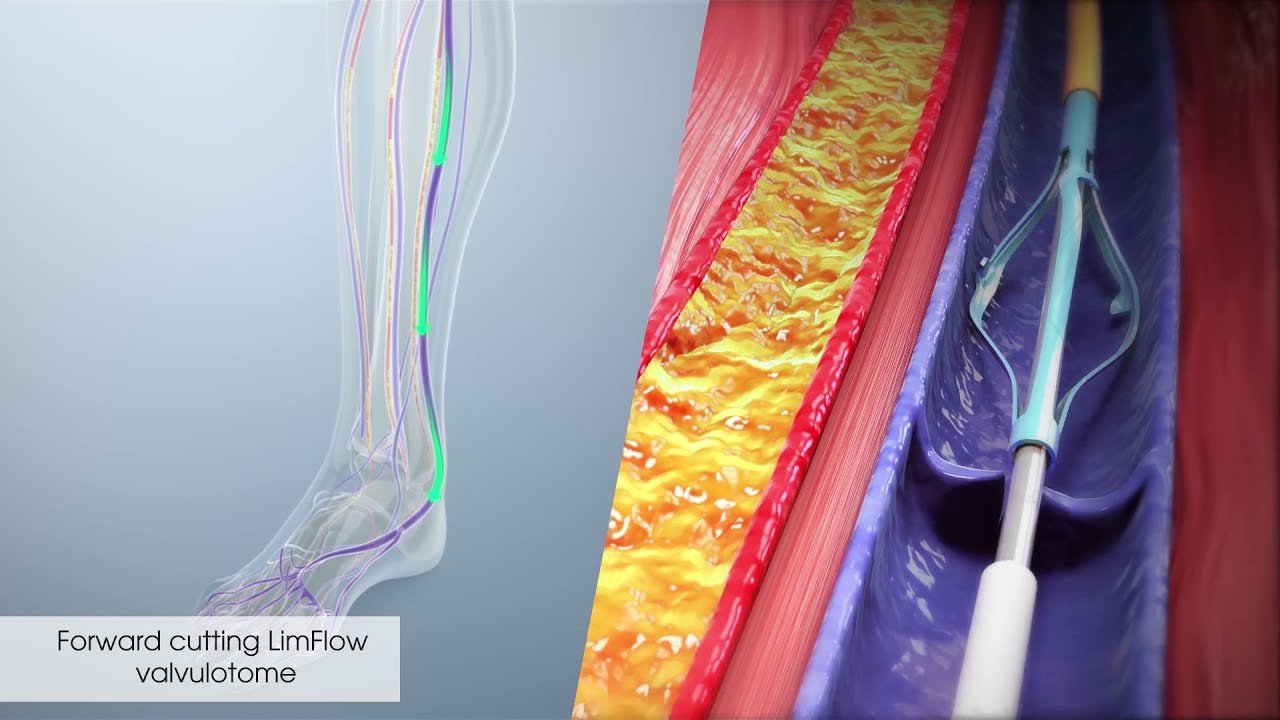 Limflow Thumbnail